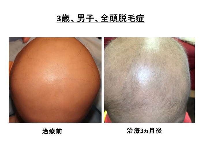 円形脱毛症　病院""